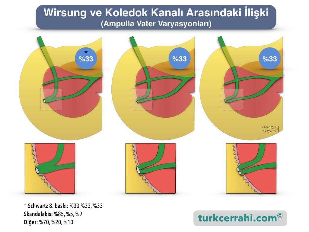 Ampulla Vater varyasyonları. Wirsung ve koledok kanalı arasındaki ilişki.