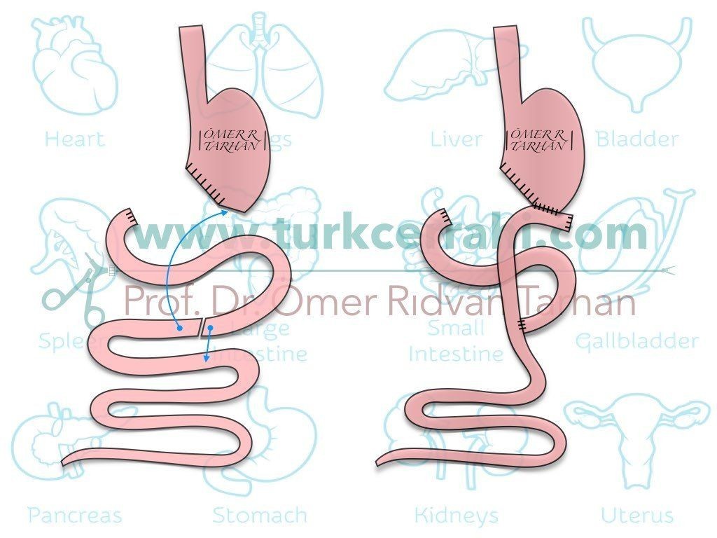 Antrektomi Roux en Y Gastrojejunostomi