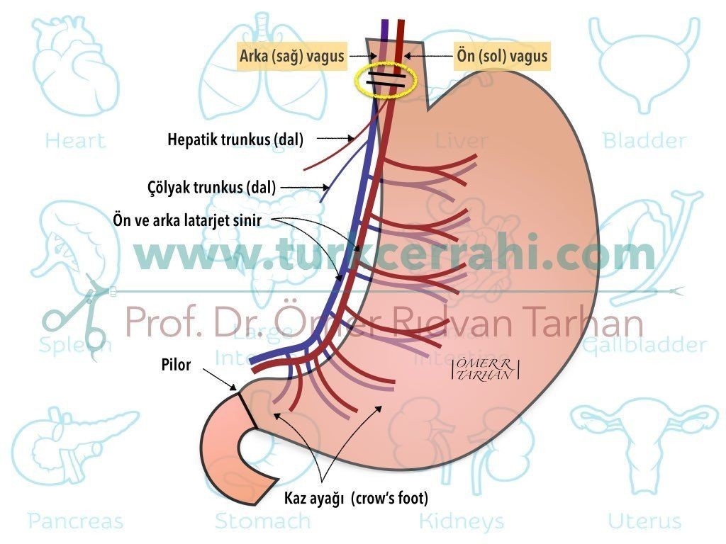 Bilateral Trunkal Vagotomi Bilateral Truncal Vagotomy BTV