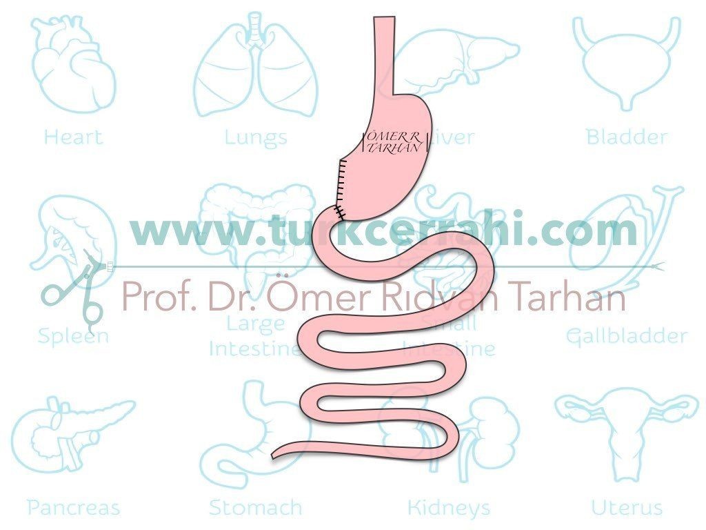 Bilroth I gastrektomi ameliyati