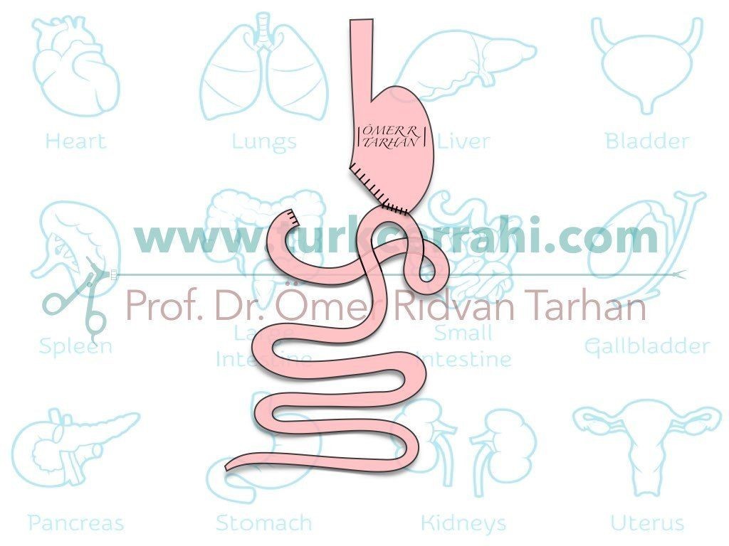 Bilroth II gastrektomi ameliyati kısa urve