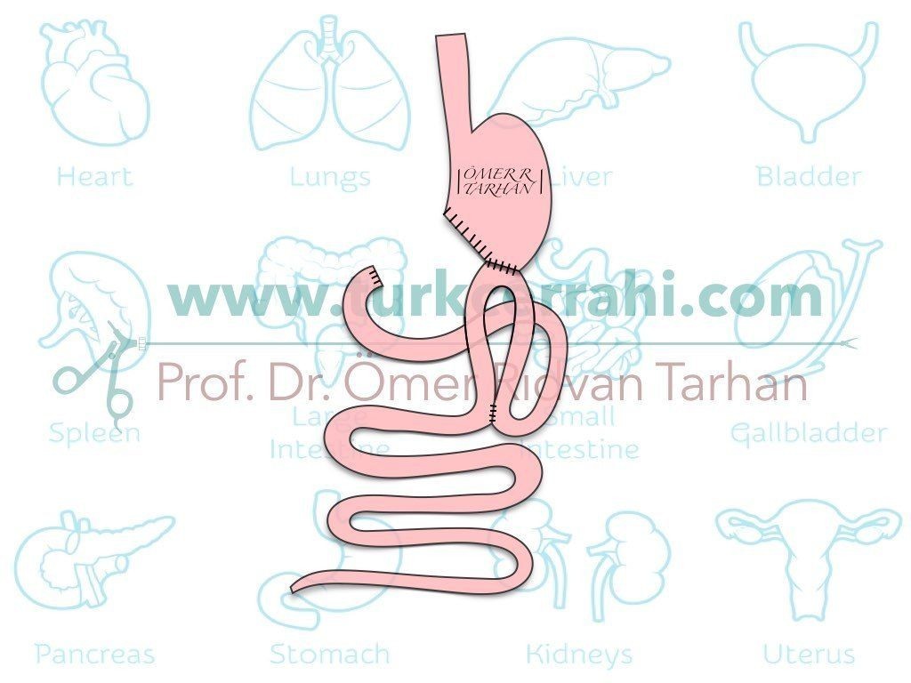 Bilroth II gastrektomi ameliyati uzun urve Braun anastomoz