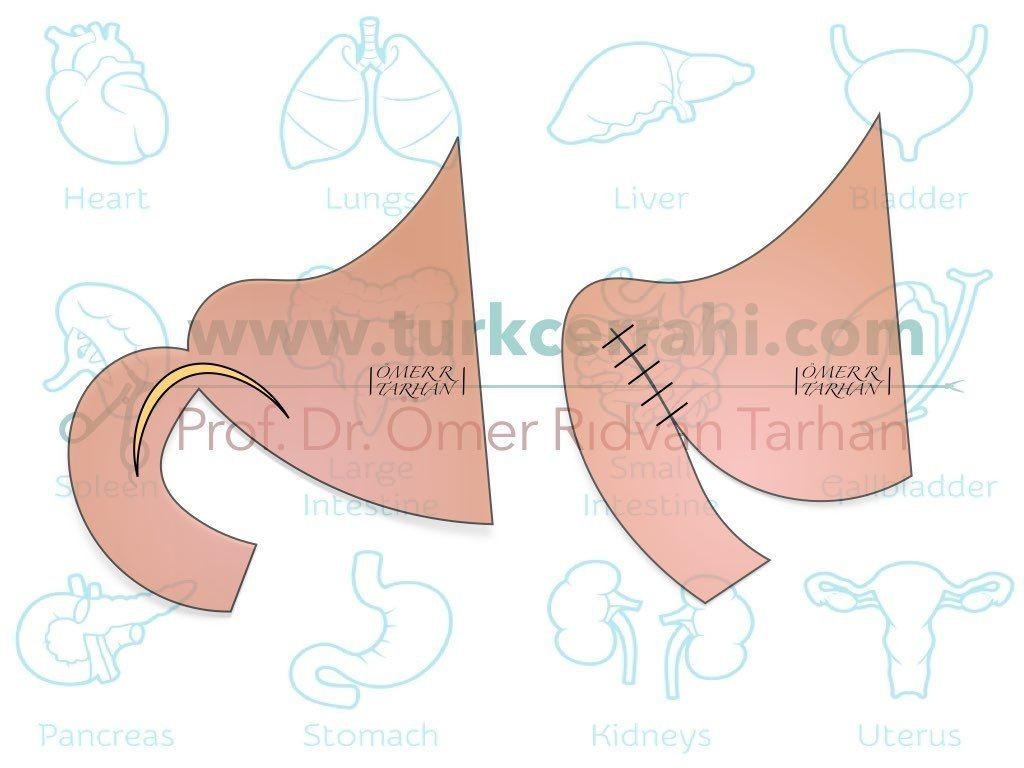 Finney piloroplasti pyloroplasty