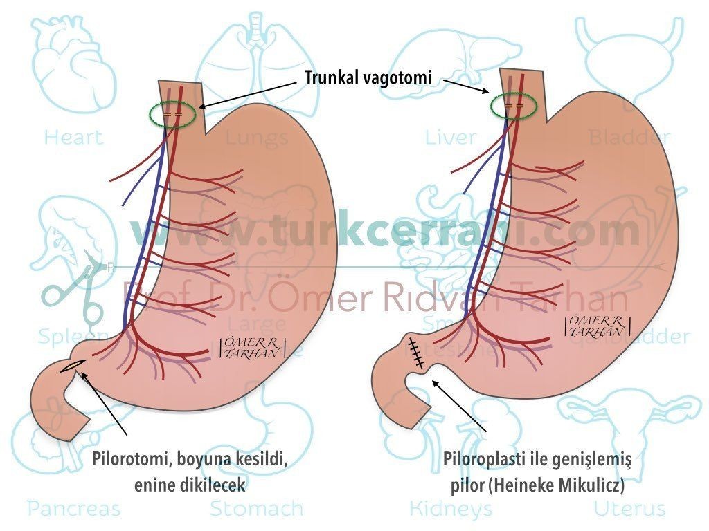 Heineke Mikulicz piloroplasti pyloroplasty