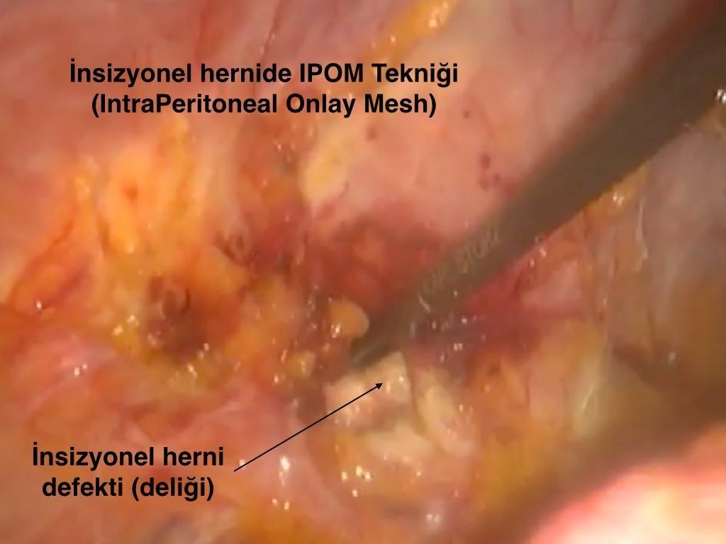IPOM intra peritoneal onlay mesh onarım