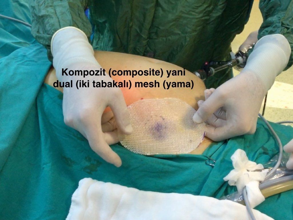 IPOM intra peritoneal onlay mesh onarım: Kompozit yama (dual mesh)