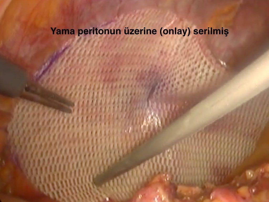 IPOM intra peritoneal onlay mesh onarım: Yamanin tespiti