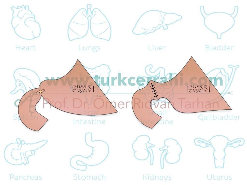 Judd piloroplasti pyloroplasty