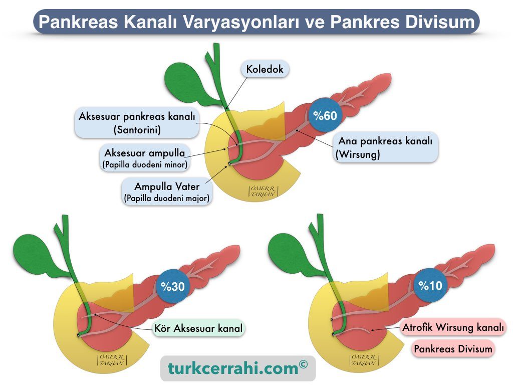 Pankreas divisum, Wirsung ve Santorini kanal varyasyonları