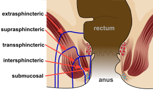 anal fistül