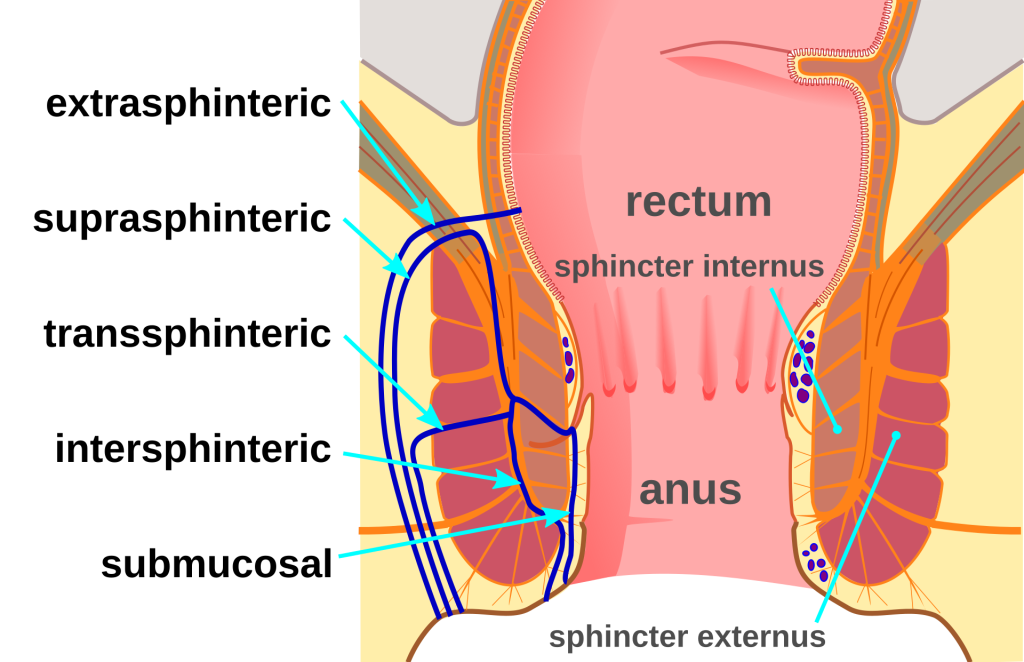 Anal fistula types