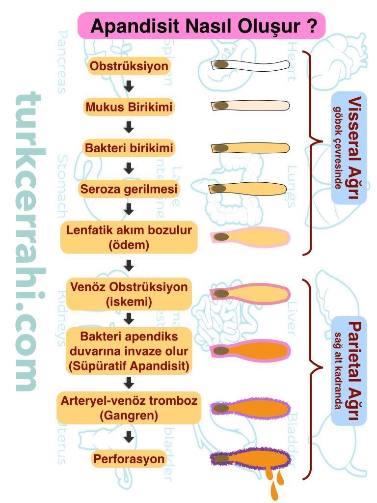Apandisit nasıl oluşur ve evreleri