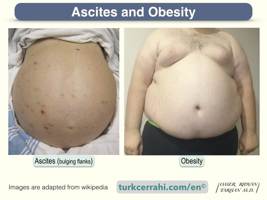 Ascites and obesity