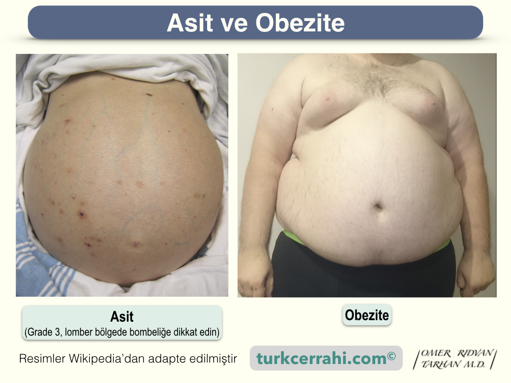 Asit ve obezite