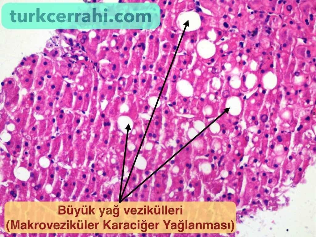 Basit karaciğer yağlanması (hepatosteatoz)