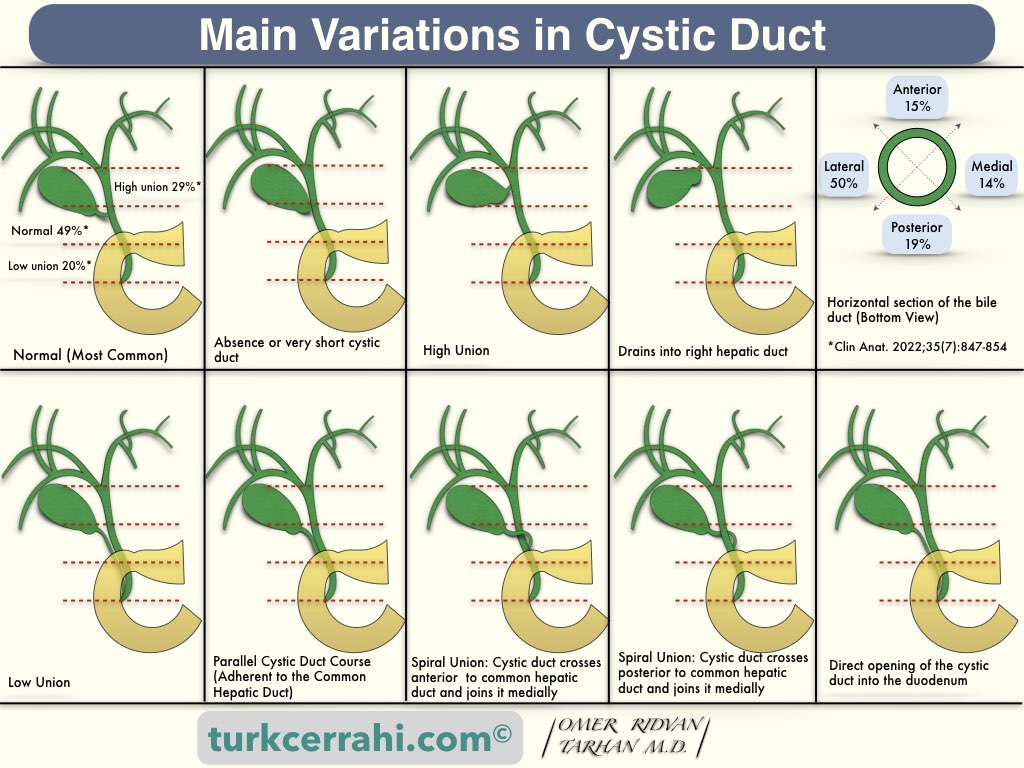 Cystic duct variations