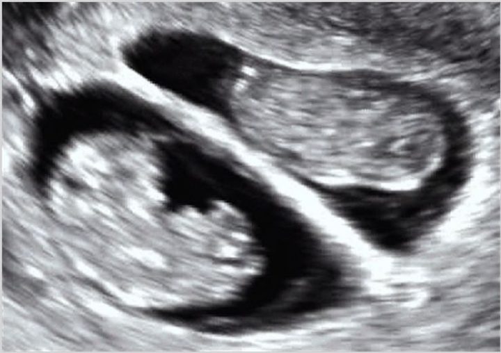 Ekojenite, 9 haftalık ikiz bebeklerin gövdesi ekojen (beyaz), içinde bulundukları amnion sıvısı ise hipoekojen (siyah) olarak görülüyor
