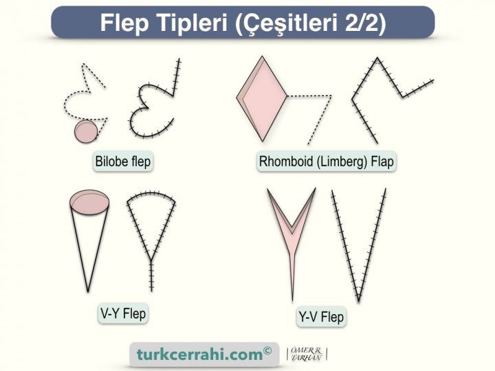 Flep çeşitleri; bilobe, rhomboid (Limberg), V-Y ve Y-V flebi