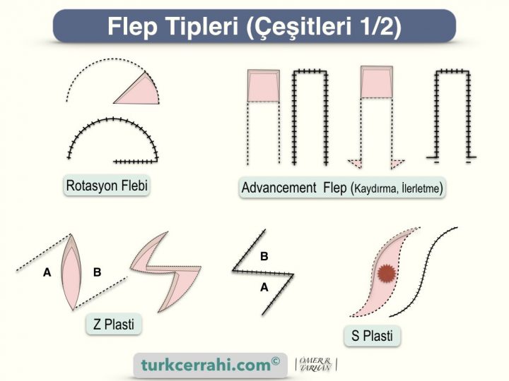 Flep çeşitleri; rotasyon, advancement (ilerletme-kaydırma) flebi, Z ve S plasti