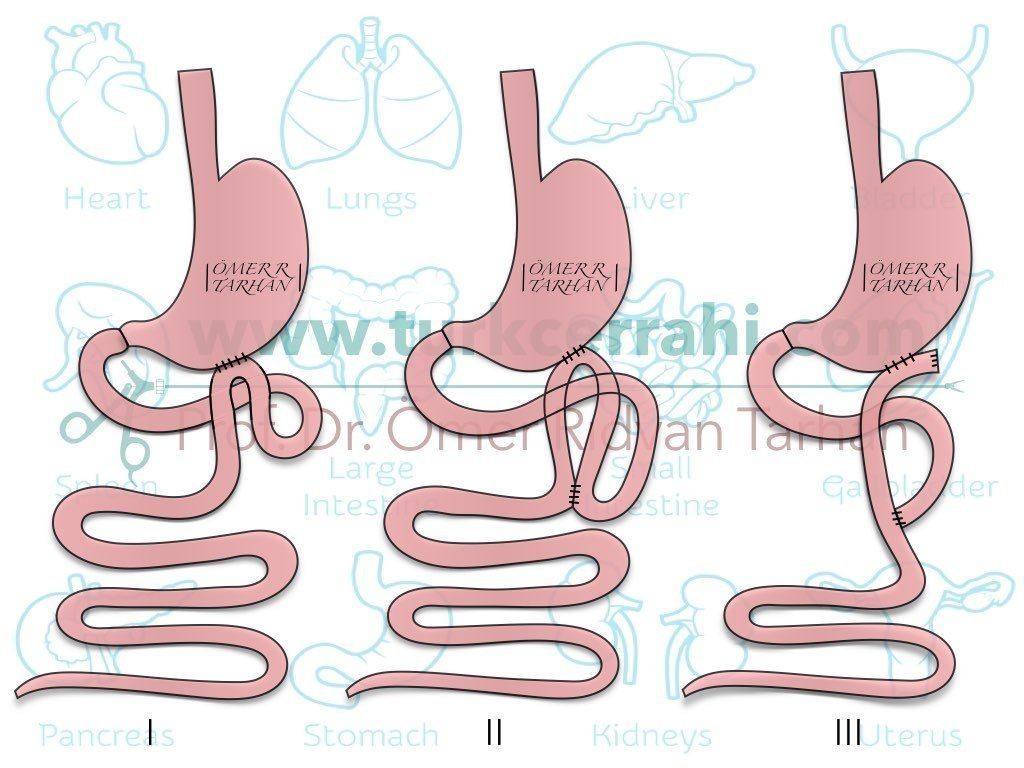 gastrojejunostomi (gastrojejunostomy)