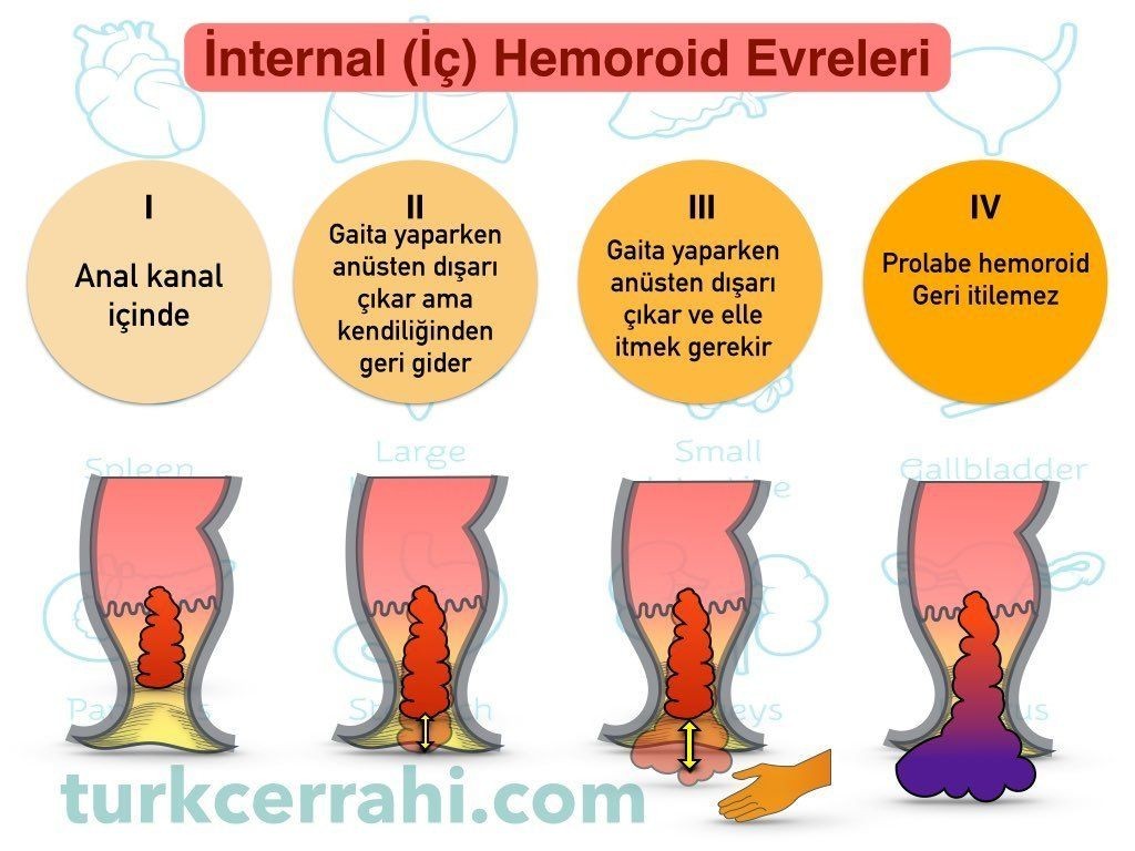 Hemoroidin evreleri
