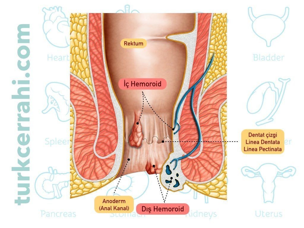 İç ve dış hemoroid