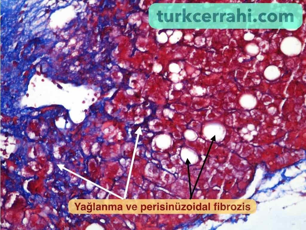 Karaciger fibrozisi (fibrozu)