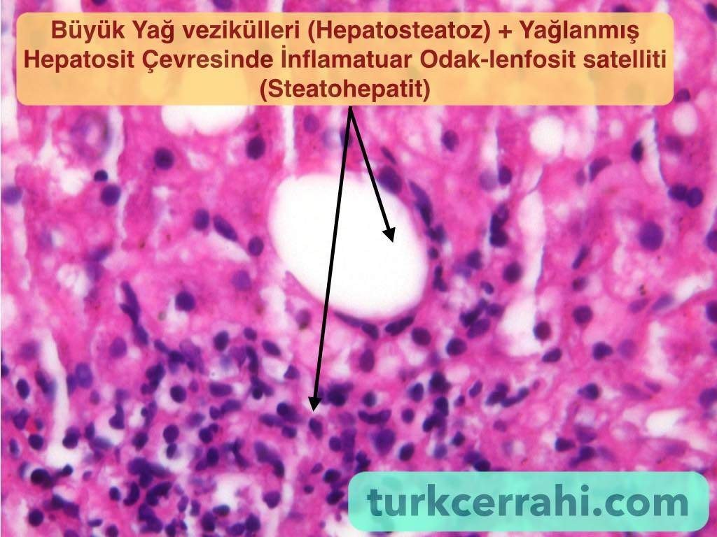 Steatohepatit