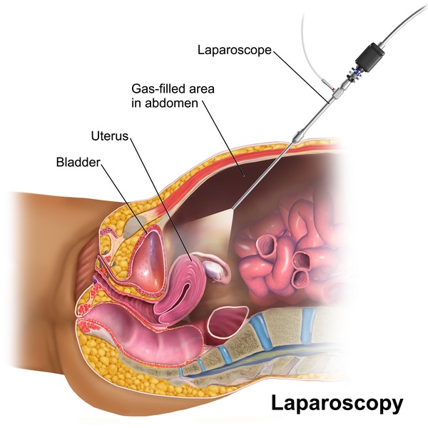 Laparoskop ve Laparoskopi
