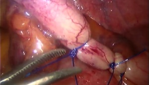 laparoskopik apendektomi-roeder knot