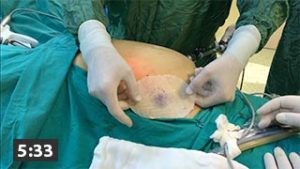 laparoskopik insizyonel herni onarimi