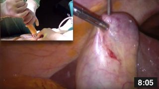 laparoskopik kolesistektomi-akut kolesistit