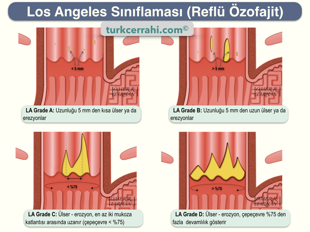 Reflü Özofajitte Los Angeles Sınıflaması