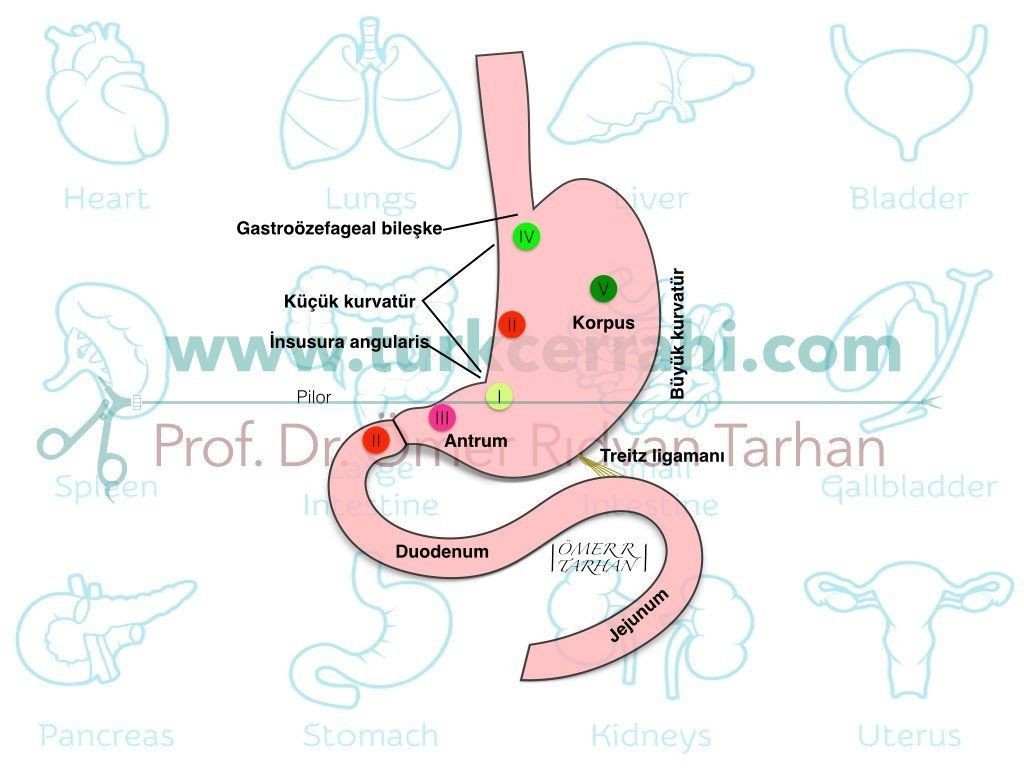 Gastrik Ülser (mide ülseri) tipleri