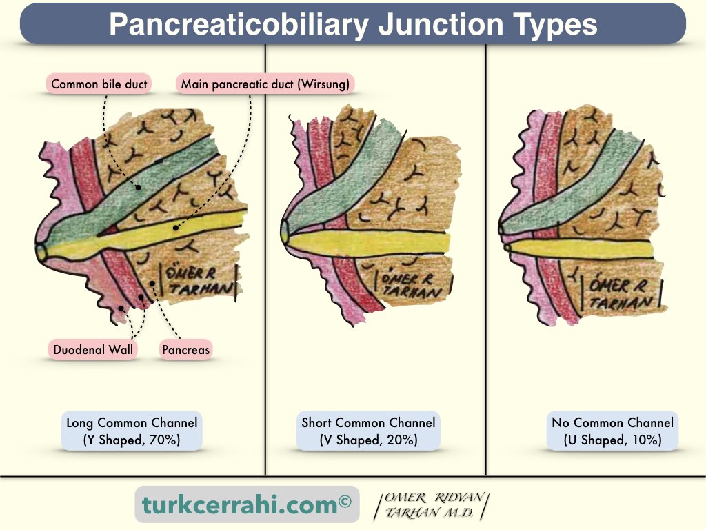 Pancreaticobiliary junction types