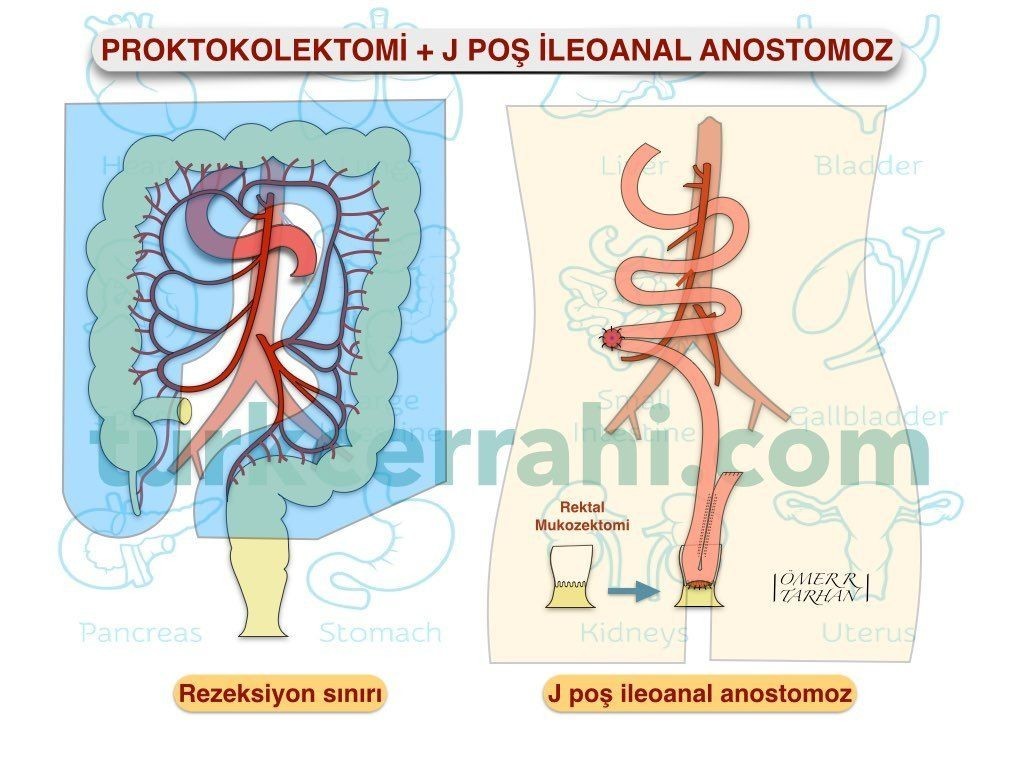 Proktokolektomi j poş ileoanal anastomoz