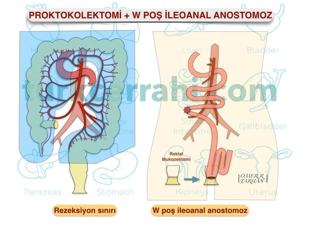 Proktokolektomi W poş ileoanal anastomoz
