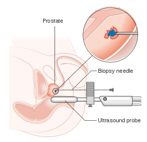 Prostat iğne biyopsisi