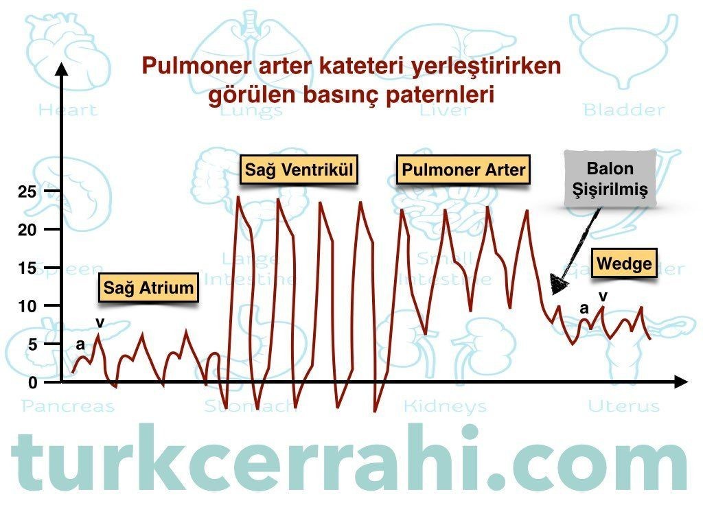 Pulmoner arter wedge basıncı nasıl ölçülür