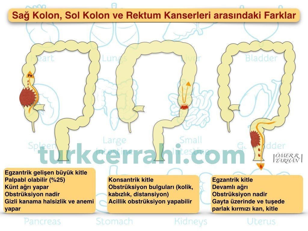 Sağ, sol kolon ve rektum kanseri arasındaki farklar