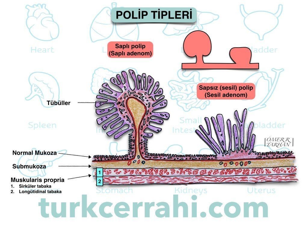 Saplı (pediküllü) ve sapsız (sesil) polip ve adenom