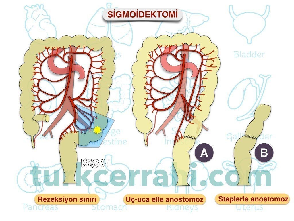 Sigmoidektomi (sigmoid rezeksiyon, kolektomi)