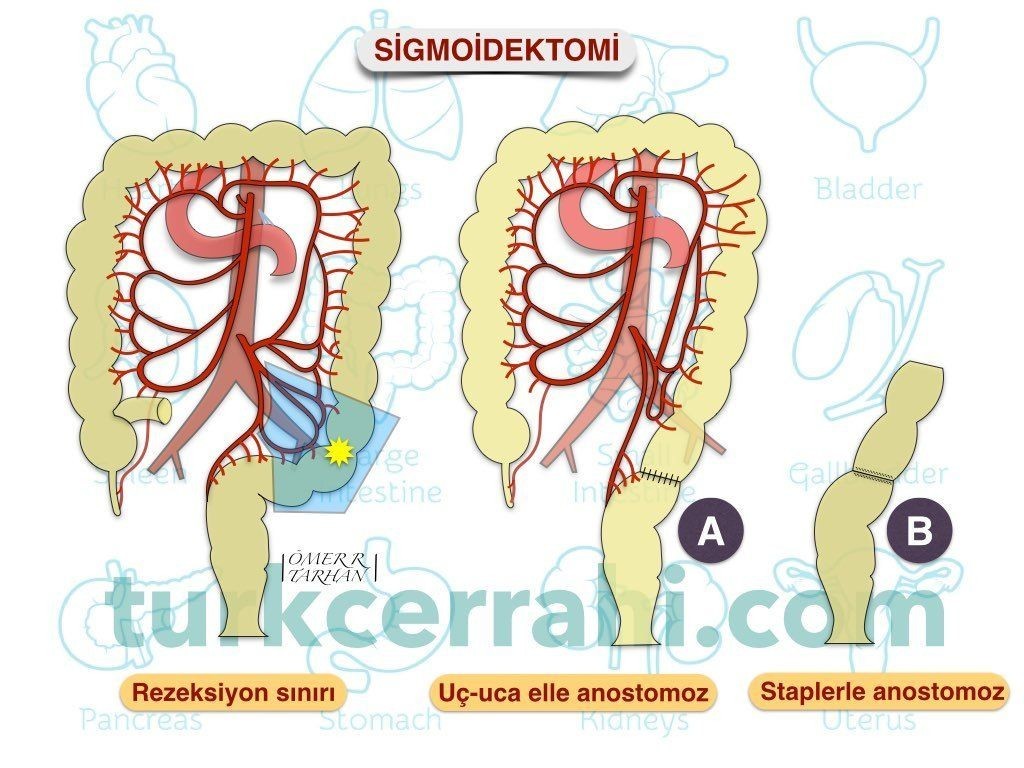Anastamoz çeşitleri ve tekniği 2