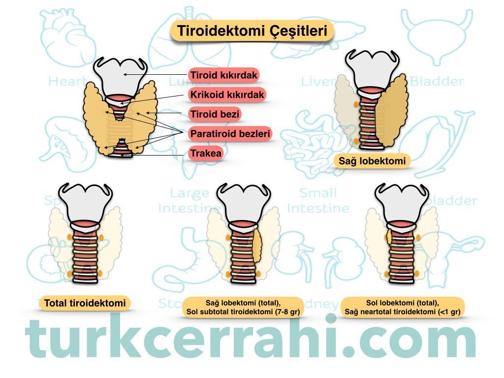 Tiroidektomi çeşitleri