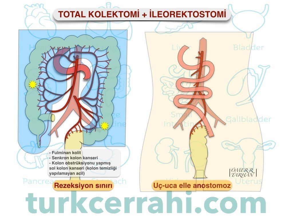 Total kolektomi ileorektal anastomoz (ileorektostomi)