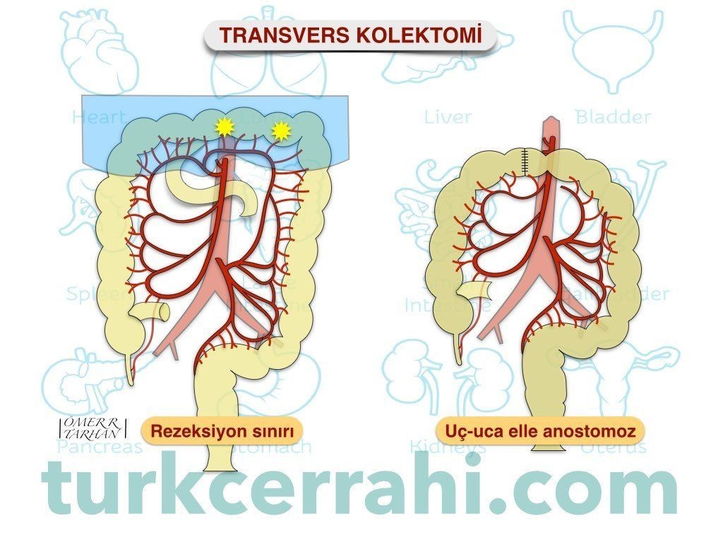 Transvers kolektomi