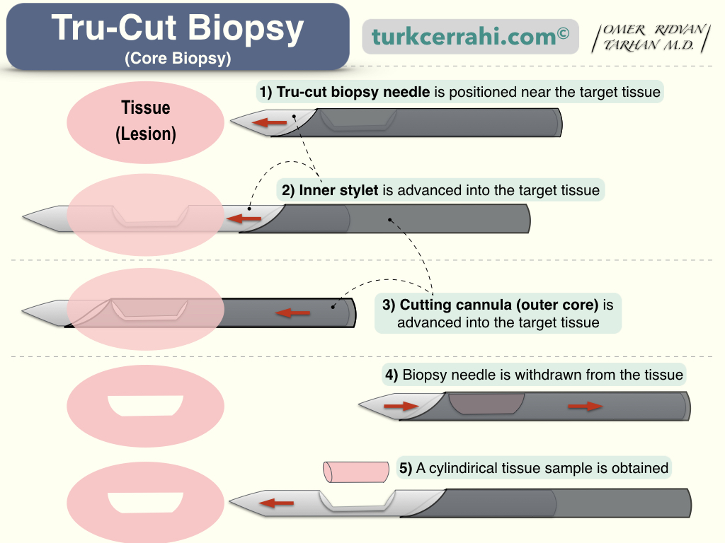 Tru cut (core) biopsy