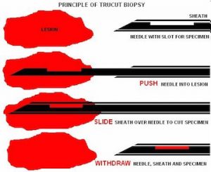 Tru cut (core) biyopsi,