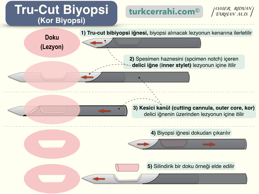 Tru cut biyopsi (kor biyopsi)