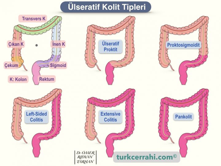 Ülseratif kolit tipleri